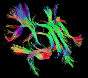 An image of the brain's white matter